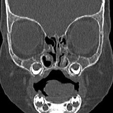 Choanal atresia (Radiopaedia 88525-105975 Coronal bone window 29).jpg