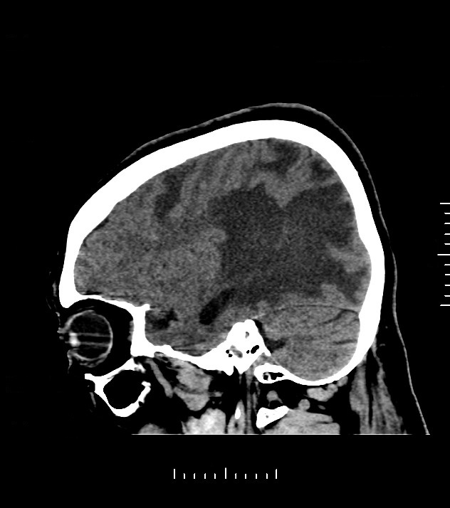 Cholangiocarcinoma with cerebral metastases (Radiopaedia 83519-98628 C 14).jpg
