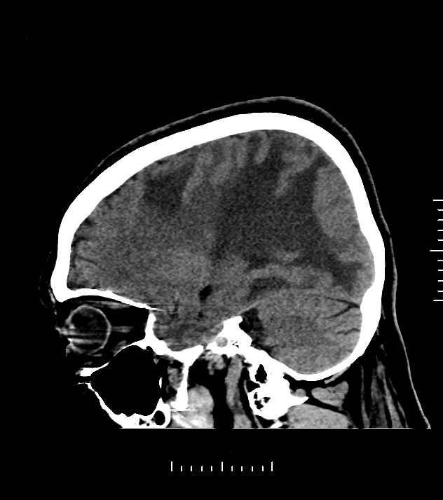 Cholangiocarcinoma with cerebral metastases (Radiopaedia 83519-98628 C 17).jpg