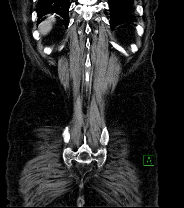 Cholangiocarcinoma with cerebral metastases (Radiopaedia 83519-98629 G 73).jpg