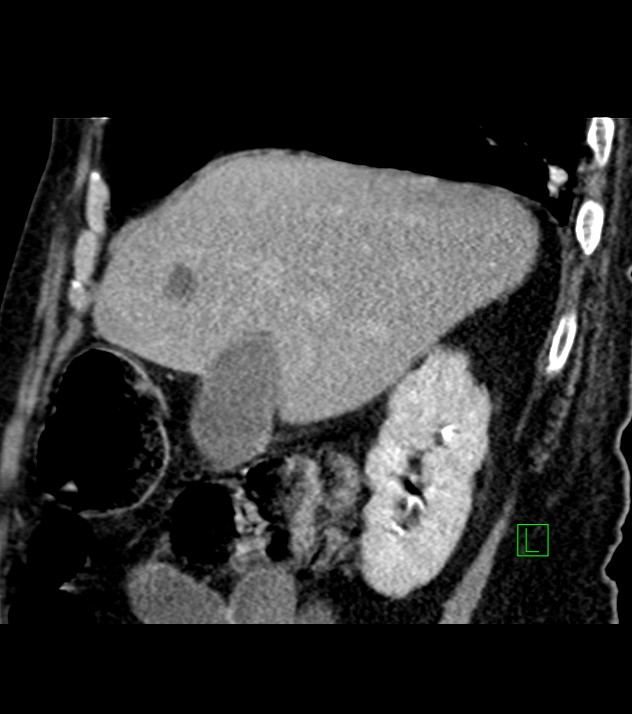 Cholangiocarcinoma with cerebral metastases (Radiopaedia 83519-98629 Sagittal C+ delayed 80).jpg