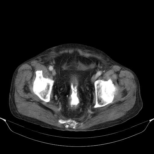 File:Cholangitis and abscess formation in a patient with cholangiocarcinoma (Radiopaedia 21194-21100 A 45).jpg