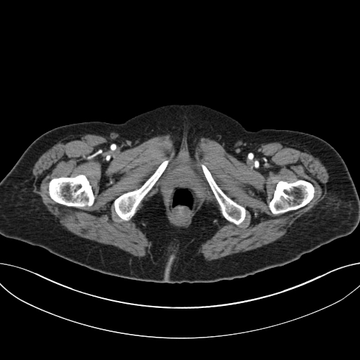 Cholecystoduodenal fistula due to calculous cholecystitis with gallstone migration (Radiopaedia 86875-103077 A 79).jpg