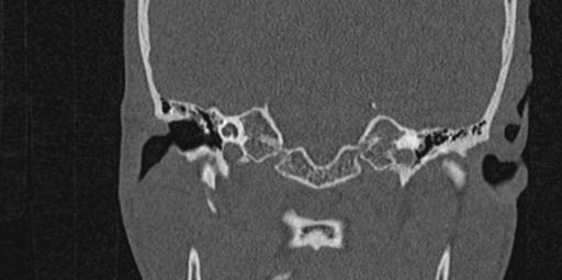 File:Cholesteatoma (Radiopaedia 70429-80529 Coronal bone window 10).jpg
