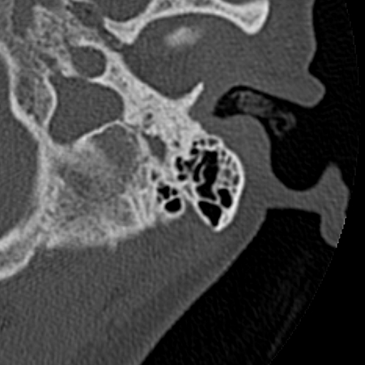 File:Cholesteatoma of the external ear (Radiopaedia 16540-16225 Axial bone window 31).jpg