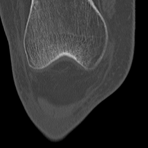 Chondrocalcinosis (Radiopaedia 16275-15955 Coronal bone window 17).jpg