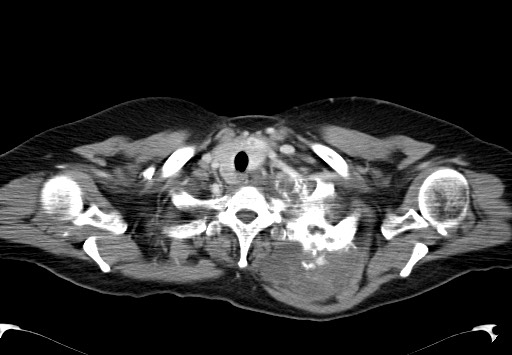 File:Chondrosarcoma - chest wall (Radiopaedia 65192-74199 C 6).jpg