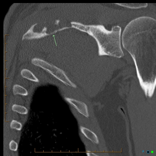 File:Chondrosarcoma of the scapula (Radiopaedia 30696-31399 Coronal non-contrast 1).jpg