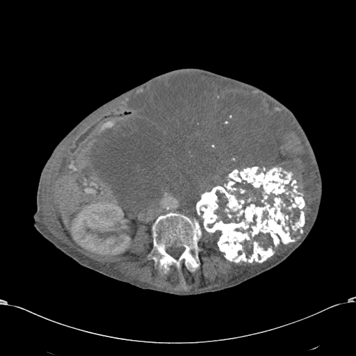 Chondrosarcoma of the spine (Radiopaedia 49871-55143 A 34).jpg