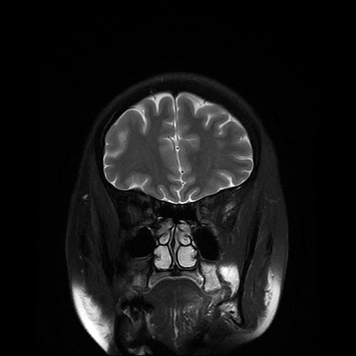 File:Chordoid glioma of third ventricle (Radiopaedia 91612-109340 Coronal T2 6).jpg