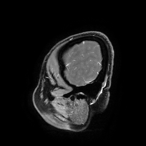 Chordoid glioma of third ventricle (Radiopaedia 91612-109340 F 183).jpg
