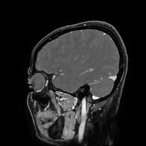 Chordoid glioma of third ventricle (Radiopaedia 91612-109340 F 62).jpg