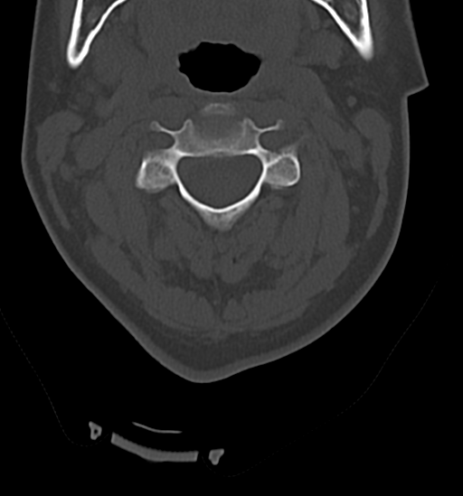 Chordoma (C4 vertebra) (Radiopaedia 47561-52188 Axial bone window 18).png