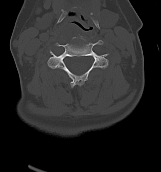 Chordoma (C4 vertebra) (Radiopaedia 47561-52188 Axial bone window 27).png