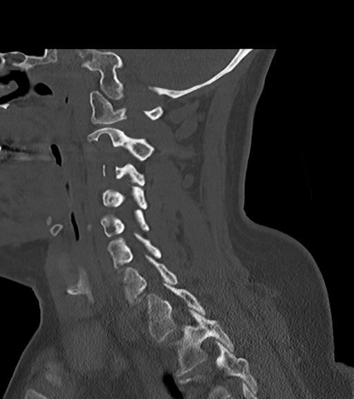 File:Chordoma (C4 vertebra) (Radiopaedia 47561-52188 Sagittal bone window 31).png