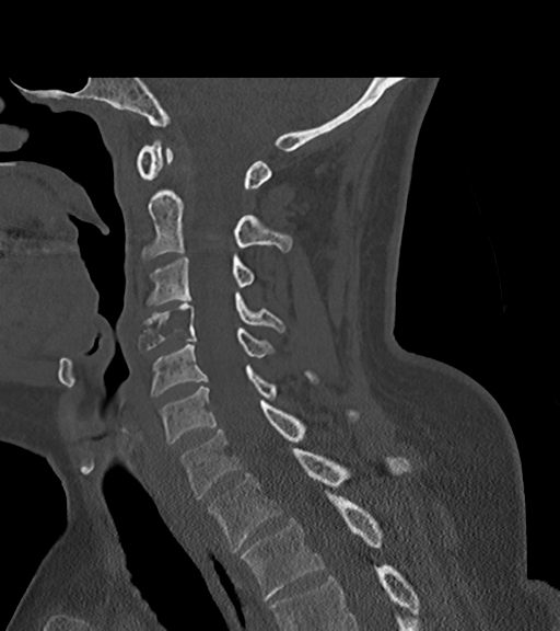 File:Chordoma (C4 vertebra) (Radiopaedia 47561-52188 Sagittal bone window 36).png