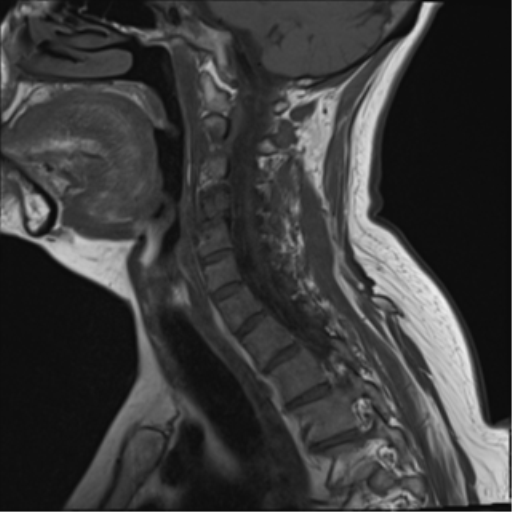 File:Chordoma (C4 vertebra) (Radiopaedia 47561-52189 Sagittal T1 4).png