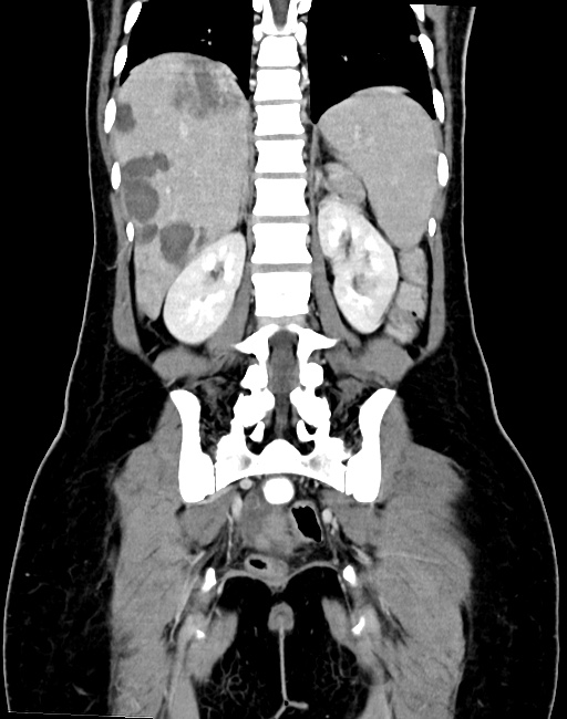 Choriocarcinoma liver metastases (Radiopaedia 74768-85766 B 71).jpg