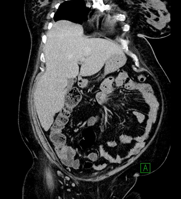 Chromophobe renal cell carcinoma (Radiopaedia 84239-99519 F 30).jpg
