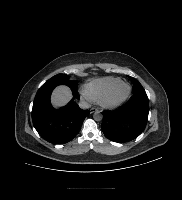 Chromophobe renal cell carcinoma (Radiopaedia 84337-99644 Axial non-contrast 3).jpg