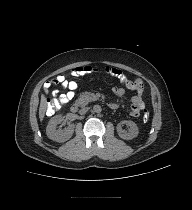 Chromophobe renal cell carcinoma (Radiopaedia 84337-99644 Axial non-contrast 43).jpg
