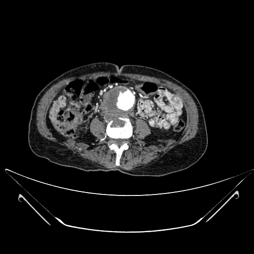 Chronic contained rupture of abdominal aortic aneurysm with extensive erosion of the vertebral bodies (Radiopaedia 55450-61901 A 37).jpg