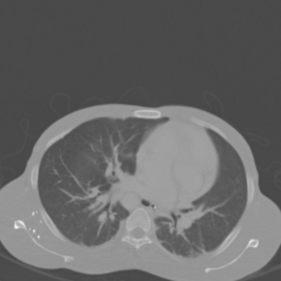 Chronic large bowel pseudo-obstruction (Radiopaedia 43181-46492 Axial bone window 13).jpg