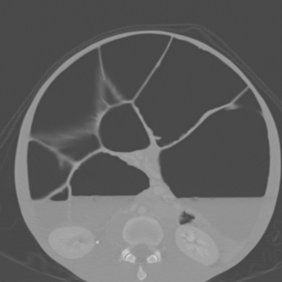 Chronic large bowel pseudo-obstruction (Radiopaedia 43181-46492 Axial bone window 95).jpg