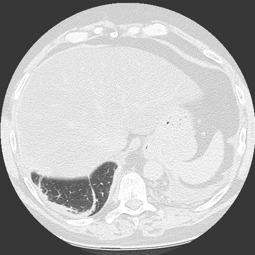 Chronic lung allograft dysfunction - restrictive form (Radiopaedia 60595-68316 Axial lung window 63).jpg