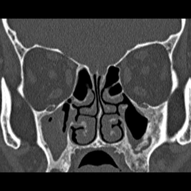 Chronic maxillary sinusitis (Radiopaedia 27879-28116 Coronal bone window 26).jpg