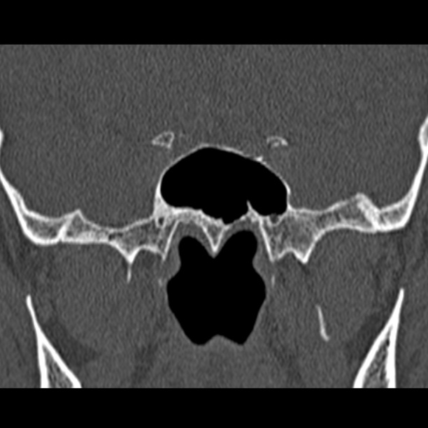 Chronic maxillary sinusitis (Radiopaedia 27879-28116 Coronal bone window 46).jpg