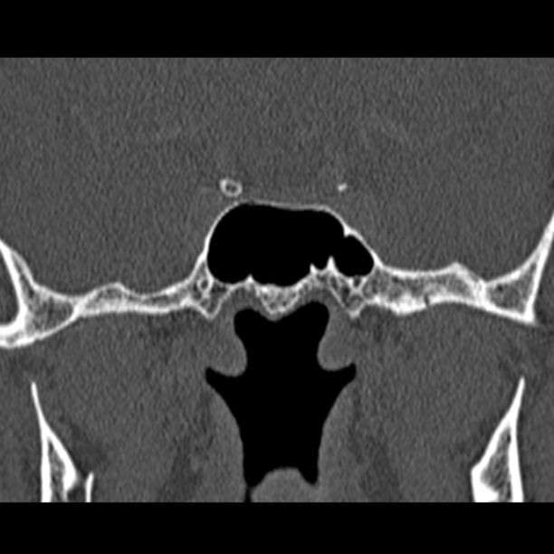 Chronic maxillary sinusitis (Radiopaedia 27879-28116 Coronal bone window 49).jpg