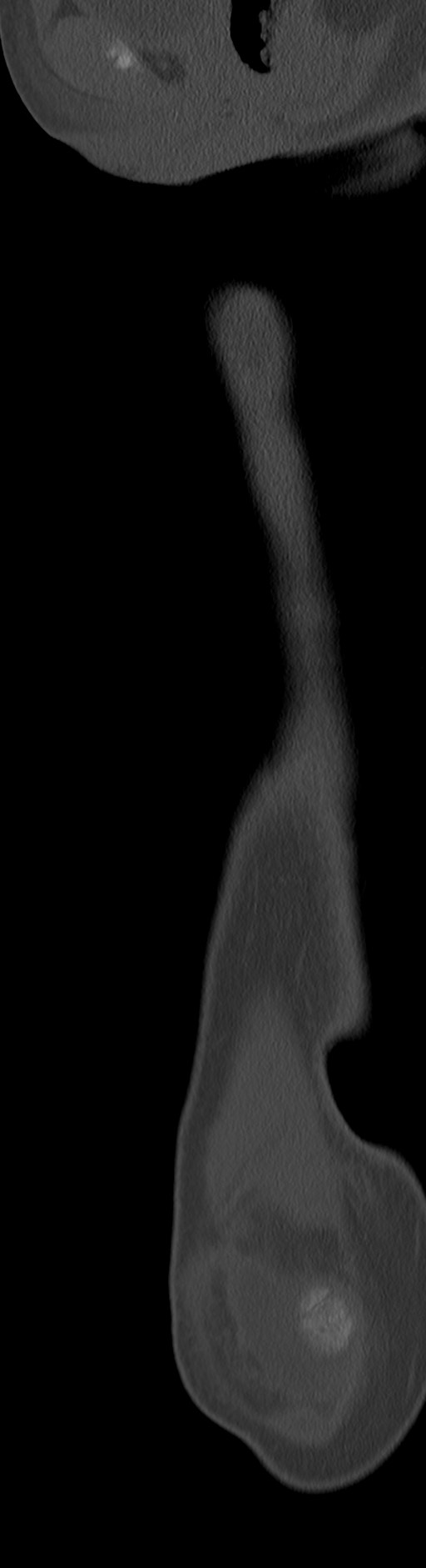 Chronic ostemyelitis of the femur with long sinus tract (Radiopaedia 74947-85982 Sagittal bone window 72).jpg