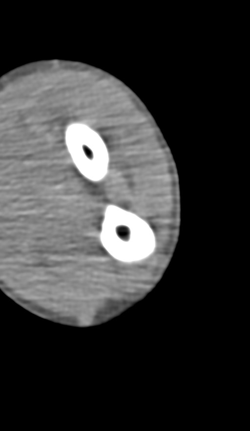 Chronic osteomyelitis of the distal humerus (Radiopaedia 78351-90971 Axial non-contrast 122).jpg