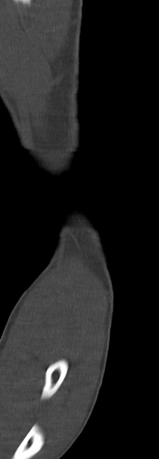 Chronic osteomyelitis of the distal humerus (Radiopaedia 78351-90971 Sagittal bone window 29).jpg