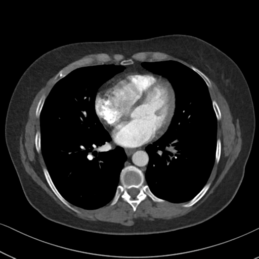Chronic pulmonary embolus (Radiopaedia 39129-41341 Axial C+ CTPA 64).png