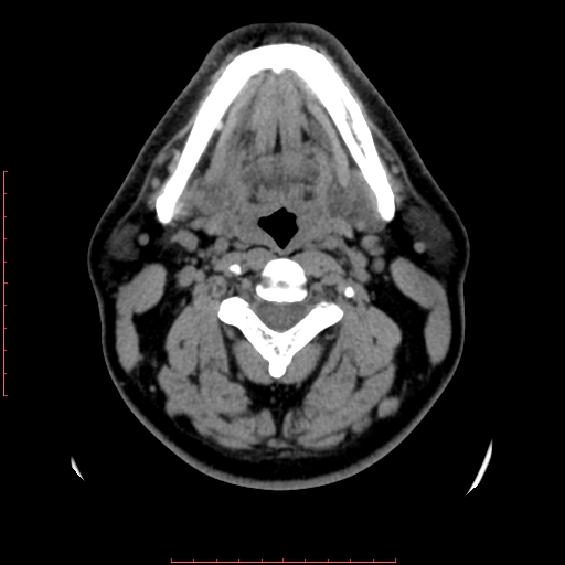 Chronic submandibular sialolithiasis (Radiopaedia 69817-79814 Axial non-contrast 109).jpg