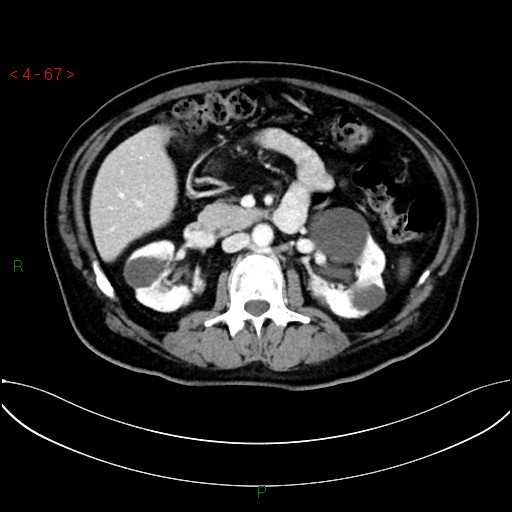 File:Circumaortic left renal vein and doubled left renal arteries (Radiopaedia 52268-58158 B 27).jpg