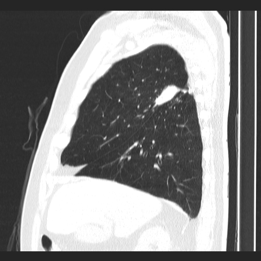 Classic complicated silicosis (Radiopaedia 49720-54961 Sagittal lung window 46).jpg
