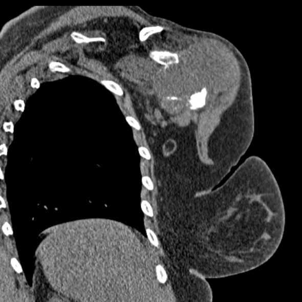 Clear cell chondrosarcoma - humerus (Radiopaedia 63104-71612 Coronal non-contrast 42).jpg