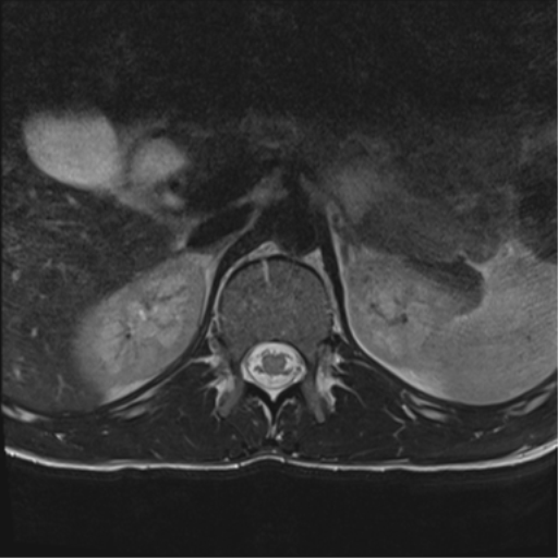 File:Clear cell meningoma - lumbar spine (Radiopaedia 60116-67690 Axial T2 45).png