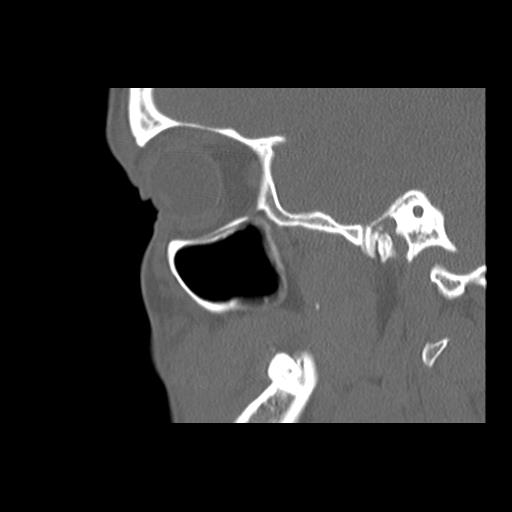 File:Cleft hard palate and alveolus (Radiopaedia 63180-71710 Sagittal bone window 16).jpg