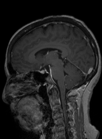 Clival meningioma (Radiopaedia 53278-59248 Sagittal T1 C+ 249).jpg