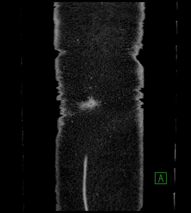 Closed-loop small bowel obstruction-internal hernia (Radiopaedia 78439-91096 Coronal non-contrast 104).jpg