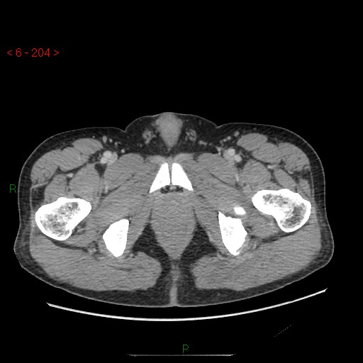 File:Closed loop obstruction and appendicular stump mucocele (Radiopaedia 54014-60163 A 124).jpg