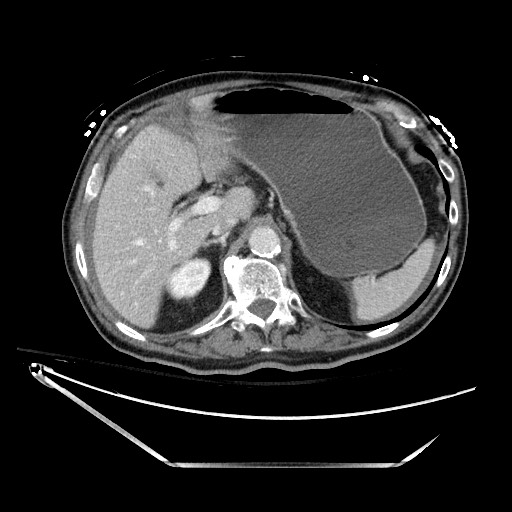 File:Closed loop obstruction due to adhesive band, resulting in small bowel ischemia and resection (Radiopaedia 83835-99023 Axial 477).jpg