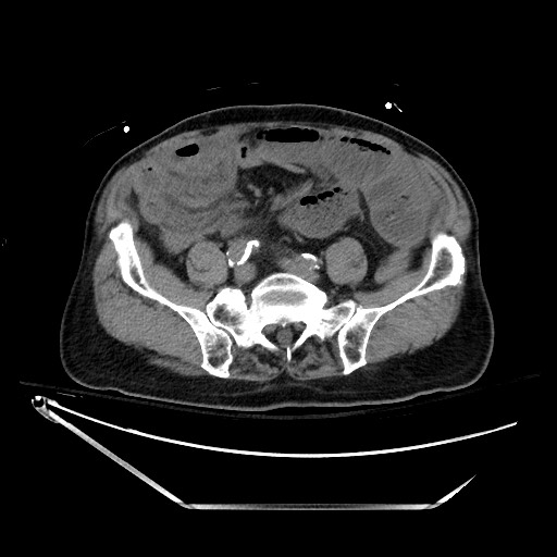Closed loop obstruction due to adhesive band, resulting in small bowel ischemia and resection (Radiopaedia 83835-99023 Axial non-contrast 107).jpg