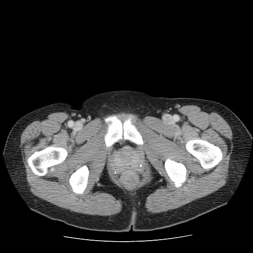 File:Closed loop small bowel obstruction (Radiopaedia 65403-74451 A 82).jpg