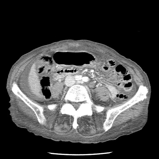 Closed loop small bowel obstruction - adhesions and infarct (Radiopaedia 85125-100678 B 58).jpg