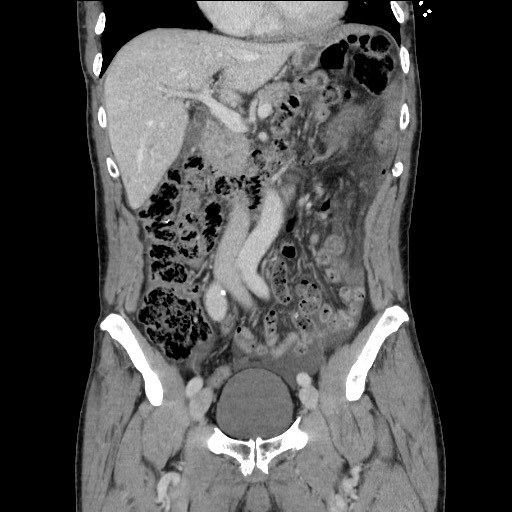 File:Closed loop small bowel obstruction - omental adhesion causing "internal hernia" (Radiopaedia 85129-100682 B 56).jpg
